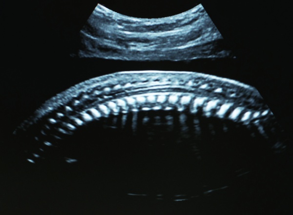 Ultraschall-Bild einer Wirbelsäule eines ungeborenen Babys