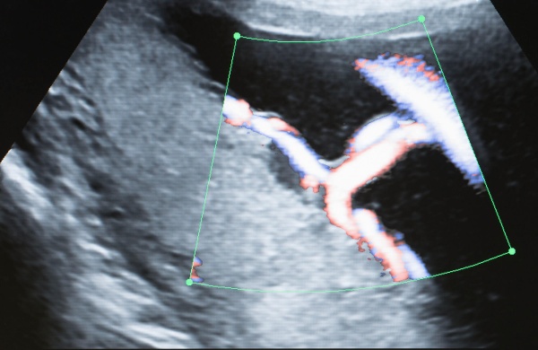 Schwarzweiß - Ultraschallbild mit farblich hervorgehobener Nabelschnur